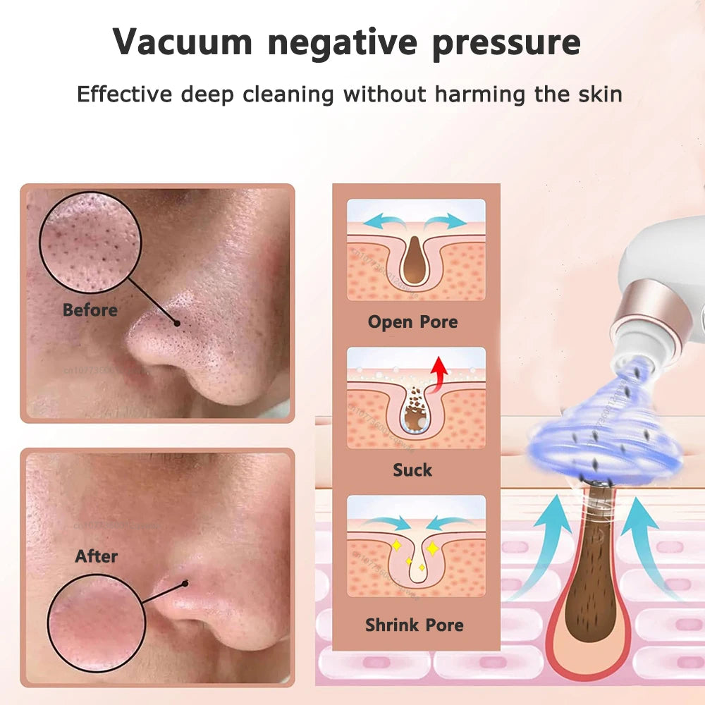 Vacuum Blackhead Remover Pore Face Cleaner Electric Pimple Acne Black Head Removal USB Rechargeable Water Cycle Black Dot Remove